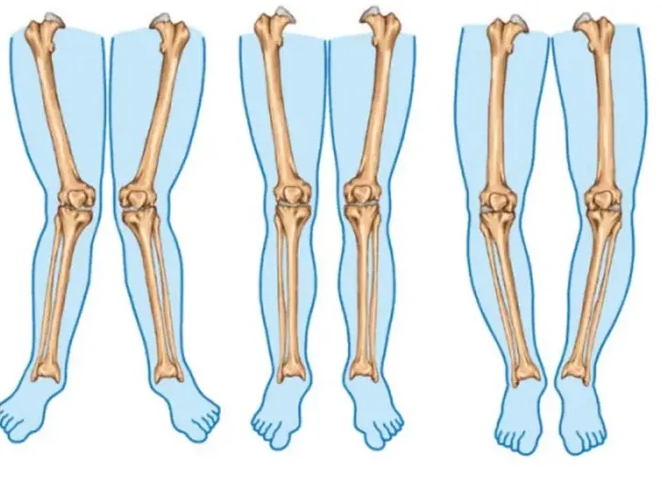 زانو ضربدری